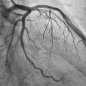 Coronary Angioplasty (PTCA) Cost in Ludhiana | Coronary Angioplasty ...